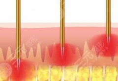 黄金微针的副作用和危害是什么？微针作用原理get！
