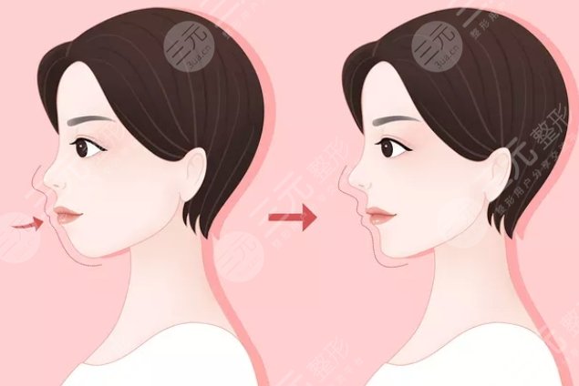 下颌角