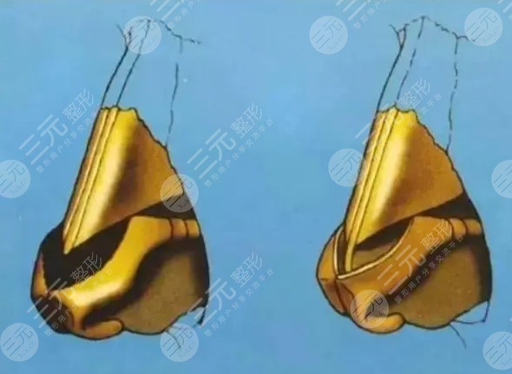 鼻综合