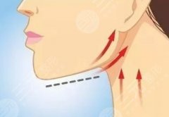 peek修复下颌骨是永久的吗？可以面部哪些问题？