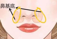 鼻基底凹陷填充多少钱?哪种材料好?科普知识汇总 鼻基底凹陷填充多少钱?哪种材料好?科普知识汇总