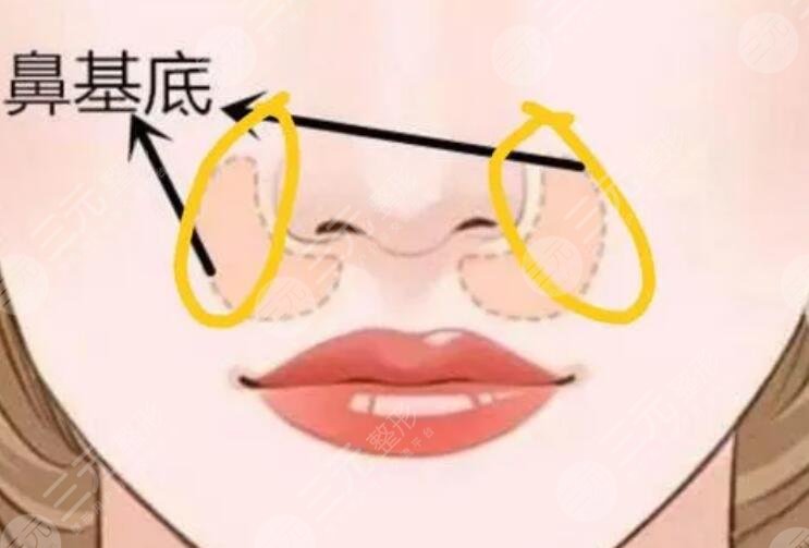 鼻基底凹陷