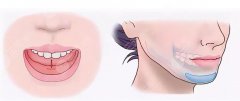 peek下巴多久能恢复?效果怎么样?科普知识汇总! peek下巴多久能恢复?效果怎么样?科普知识汇总!