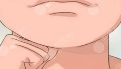 peek能填充下巴是永久的吗？效果到底好不好呢？