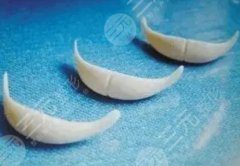 medpor下巴假体缺点是什么？隆下巴可以维持很久吗?