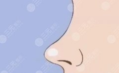 鼻修复是怎么修复的?术后多久可以恢复吗?护理方式分享 鼻修复是怎么修复的?术后多久可以恢复吗?护理方式分享