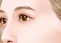 垫眉弓怎么垫好看?术后有什么后遗症吗?这几点一定要注意! 垫眉弓怎么垫好看?术后有什么后遗症吗?这几点一定要注意!