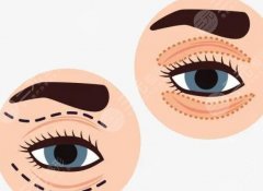 双眼皮修复需要多久可以重新做？做手术前要注意哪些问题？