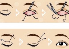 双眼皮修复适宜时间是什么时候？眼部出现哪些问题需要修复？