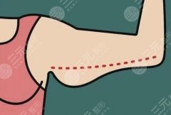 手臂吸脂的危害有哪些？术后护理及注意事项盘点！点击收藏