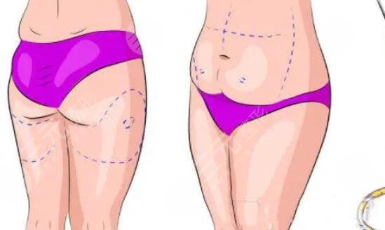 小腿吸脂