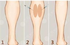 小腿吸脂安全吗？还有什么方法可以瘦腿？来看详细介绍