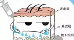 乔雅登丰颜和区别是什么?那种效果更好呢? 乔雅登丰颜和区别是什么?那种效果更好呢?