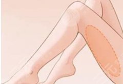 膝盖吸脂后腿会看起来直一点吗?效果如何?有什么注意事项吗? 膝盖吸脂后腿会看起来直一点吗?效果如何?有什么注意事项吗?