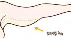 蝴蝶袖吸脂皮肤会很松吗?术后护理方法介绍! 蝴蝶袖吸脂皮肤会很松吗?术后护理方法介绍!