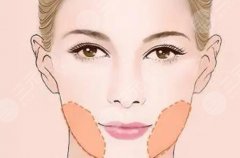 面部吸脂价格大概多少钱?作用有哪些?术后效果可以维持多久? 面部吸脂价格大概多少钱?作用有哪些?术后效果可以维持多久?