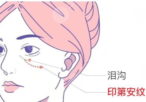 上海九院脂肪填充泪沟多少钱