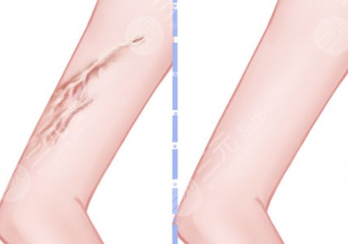 章一新疤痕怎么样