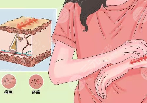 激光除疤1cm一般多少钱?其原理是什么? 激光除疤1cm一般多少钱?其原理是什么?