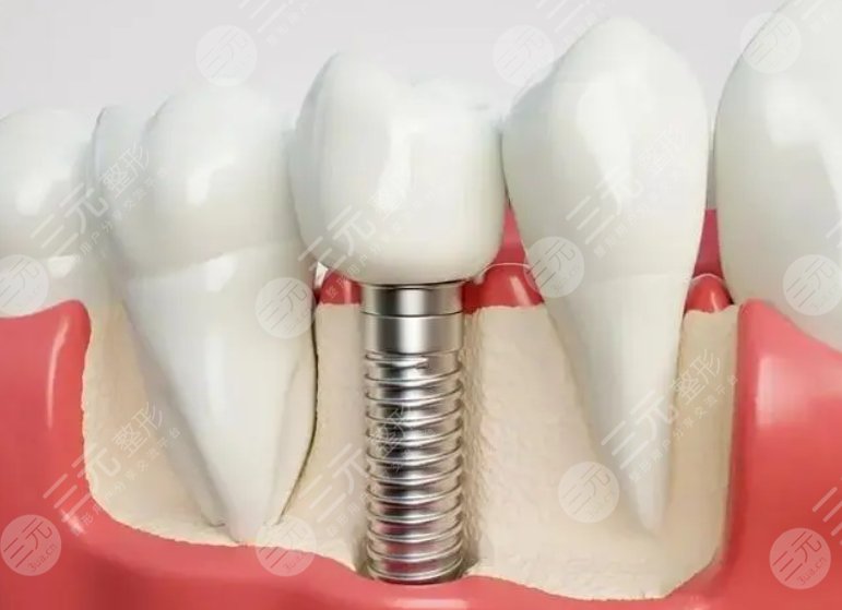 牙齿种植