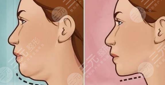 双下巴