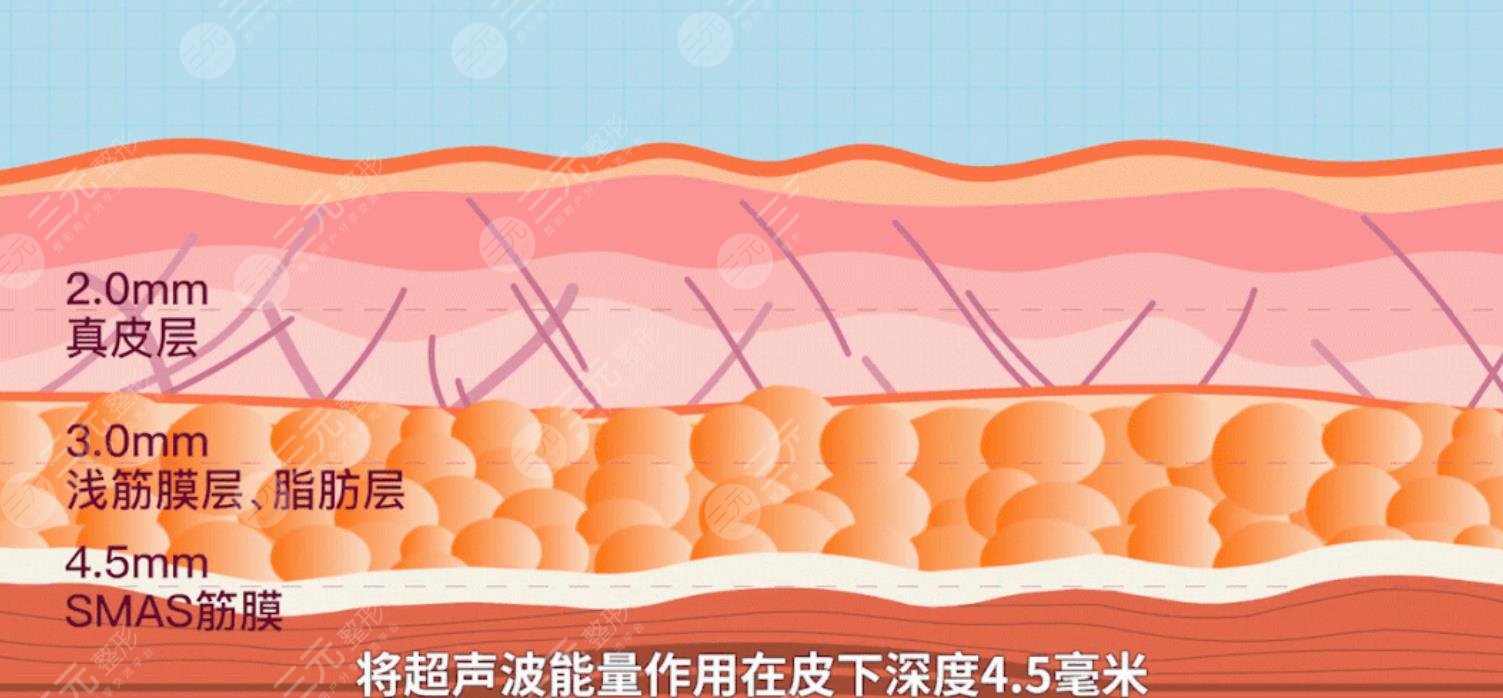超声炮抗衰