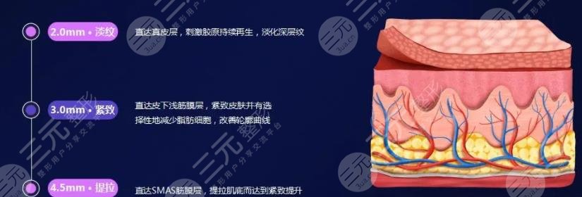 超声炮