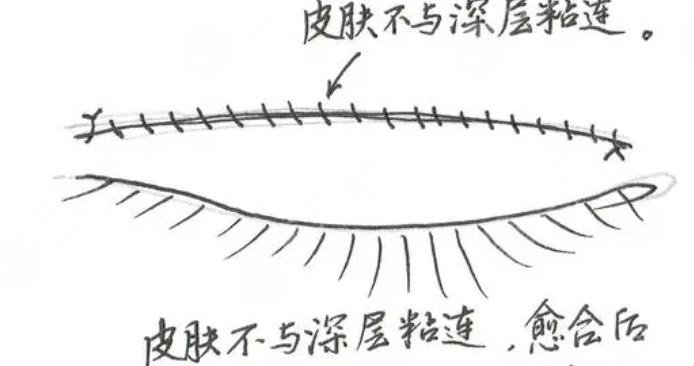 双眼皮