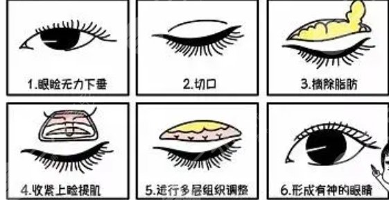 双眼皮