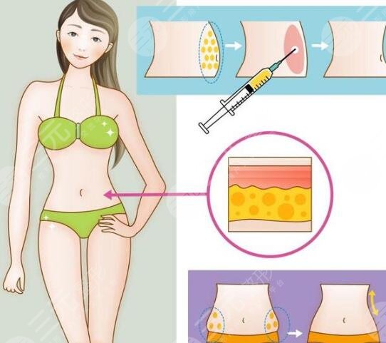 腰腹吸脂