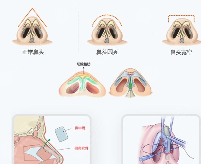 鼻综合