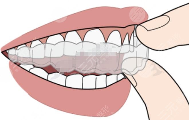 隐形牙齿矫正