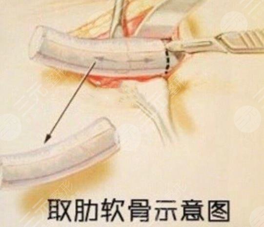 隆鼻