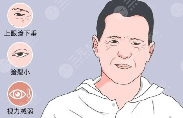 上睑下垂