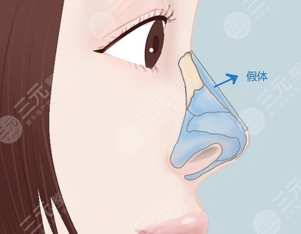 隆鼻