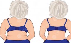 背部吸脂后疼吗？恢复期是多久？术后注意事项盘点！