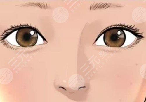 曹卫刚医生双眼皮修复怎么样