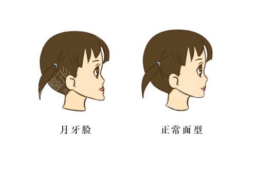 吉大一院正颌手术还是吉大口腔正颌好