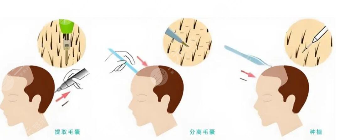 植发