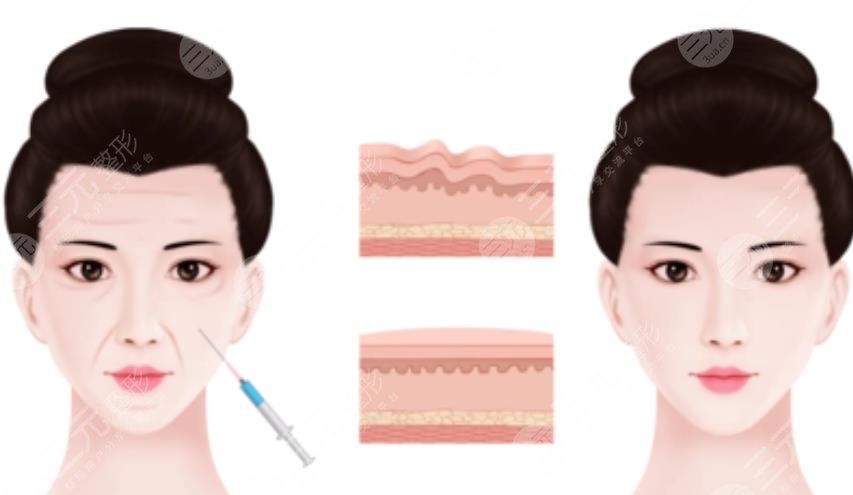 注射除皱