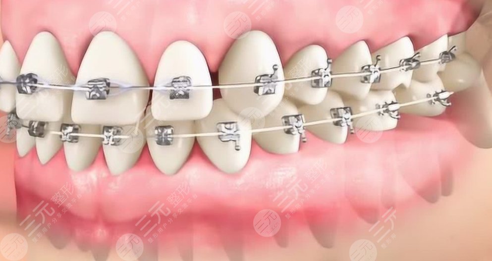 牙齿矫正