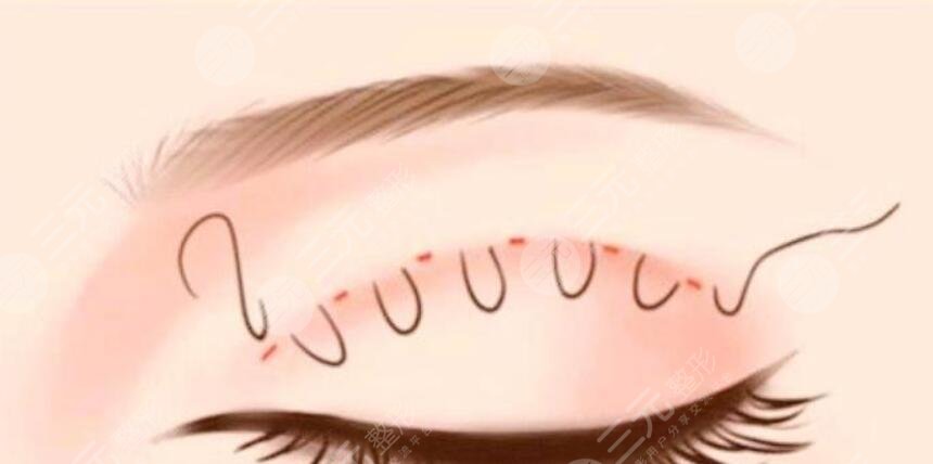 双眼皮修复