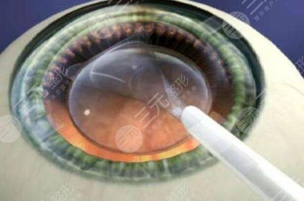 准分子激光近视矫正