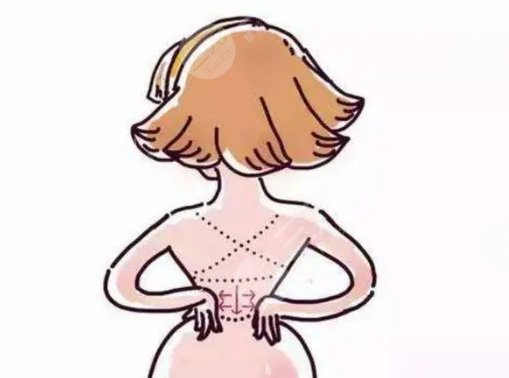 吸脂瘦后背