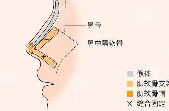 隆鼻