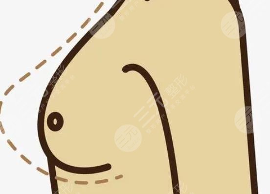 隆胸