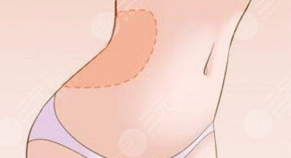 腰腹吸脂