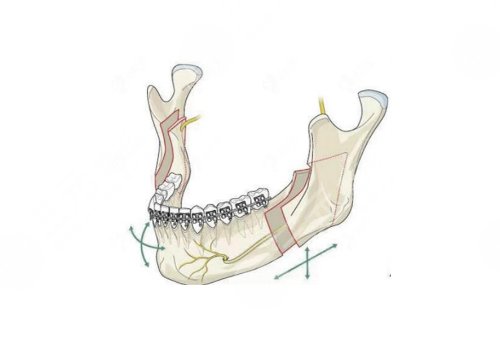 南方医院正颌手术费用需要多少