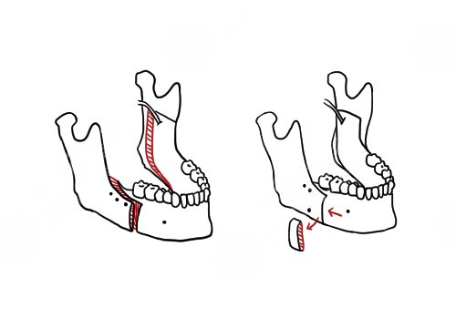 南方医院正颌手术费用需要多少