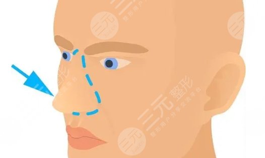 隆鼻